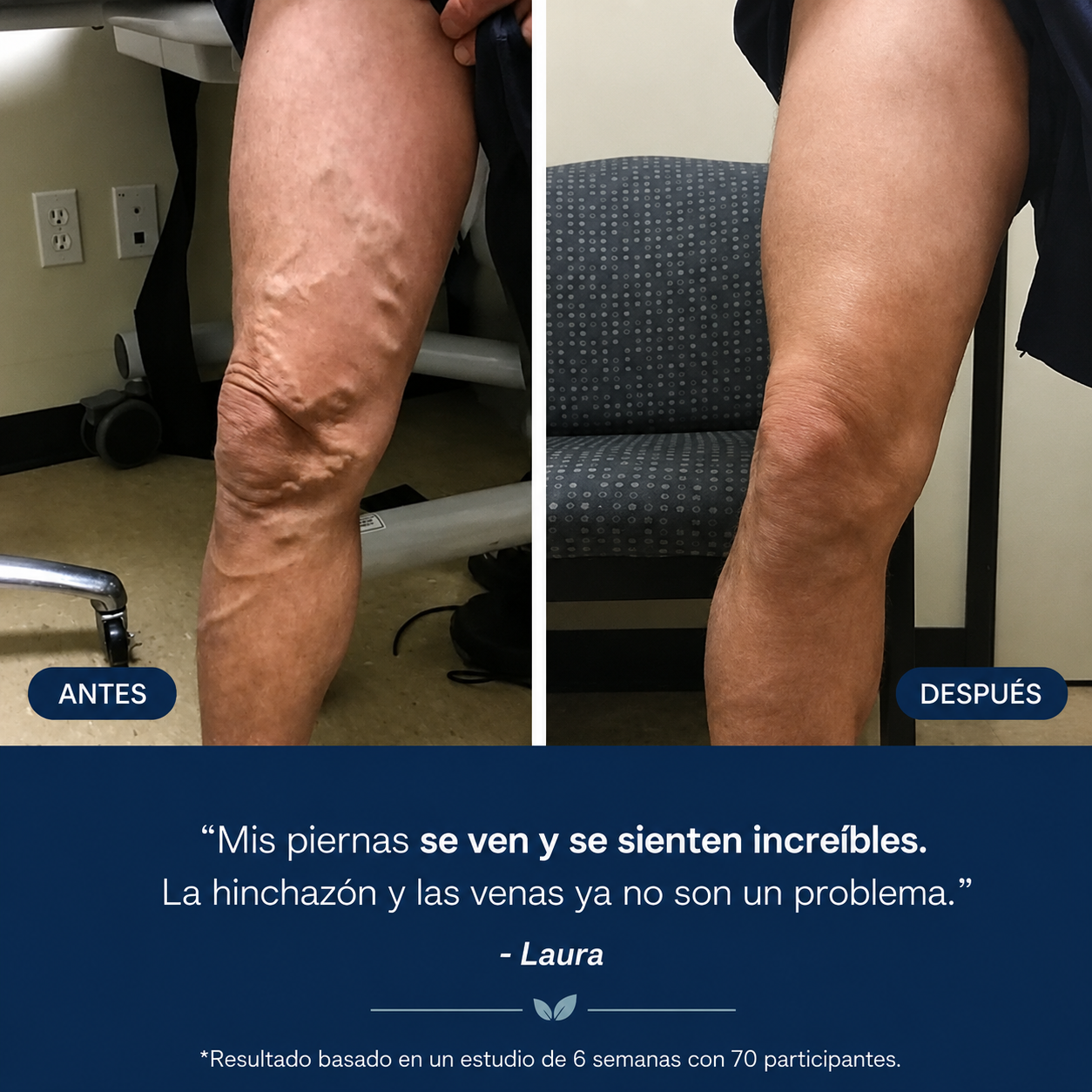 Crema para las Varices - Siente Tus Piernas Más Ligeras, Frescas y Cómodas Cada Día (Oferta 2x1)