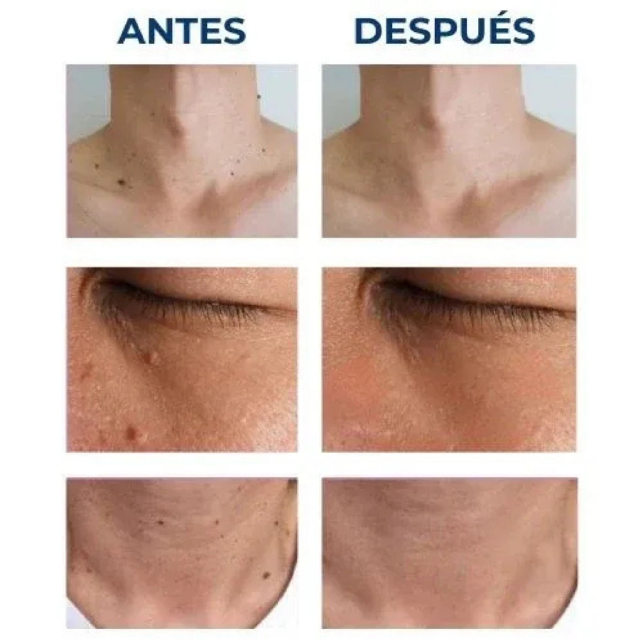 Luminiix® Eliminador de Verrugas – Fórmula Natural sin Dolor y sin Cicatrices