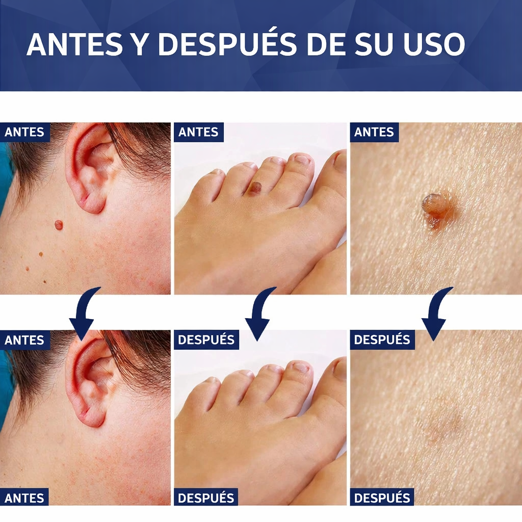 Gel para eliminar verrugas Verruxa: tratamiento avanzado para una piel limpia y sana.