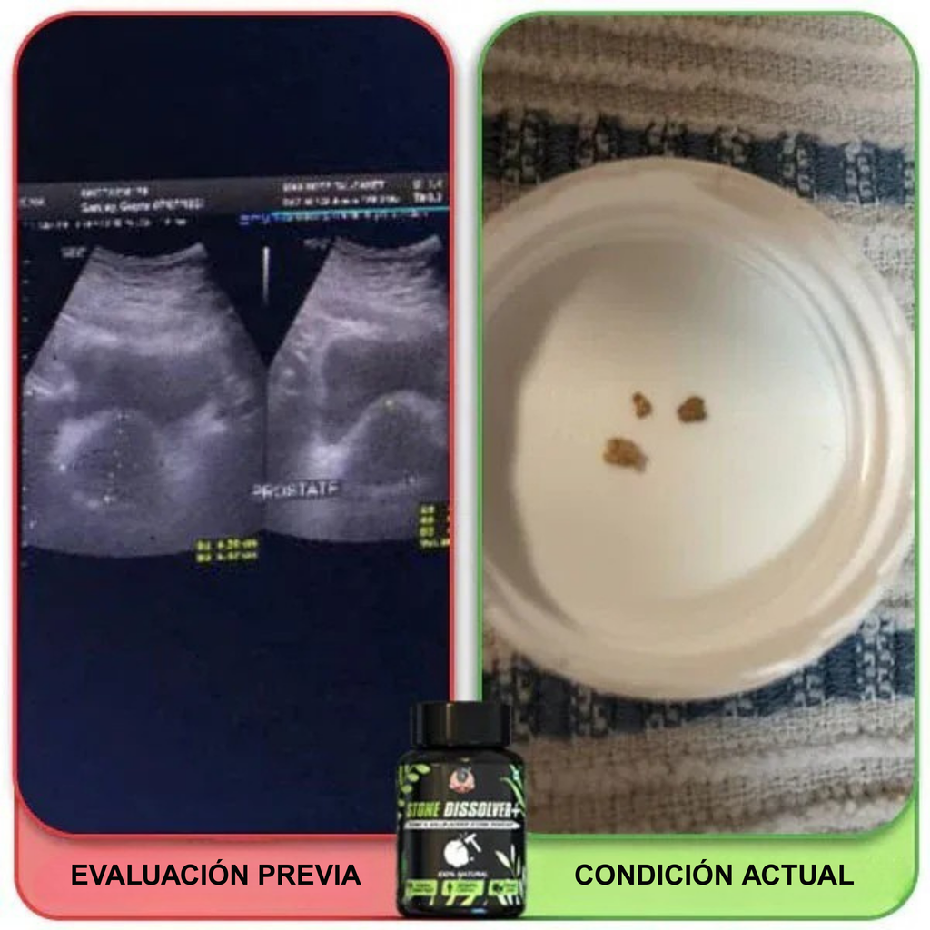 Stone Dissolver+ – Suplemento Natural para Eliminar Cálculos Renales y Proteger la Salud Urinaria
