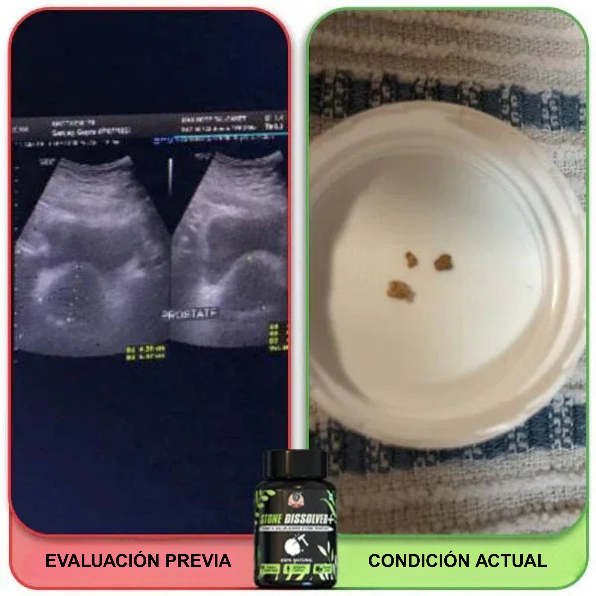 Stone Dissolver+ – Suplemento Natural para Eliminar Cálculos Renales y Proteger la Salud Urinaria