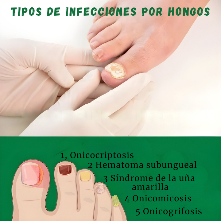 Tratamiento de 7 días para hongos en las uñas: Rápido, natural y eficaz "OFERTA 2x1"