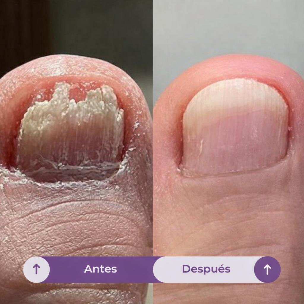 FUNGIVEX: El aceite que elimina el 99.9% de los hongos en tus uñas.