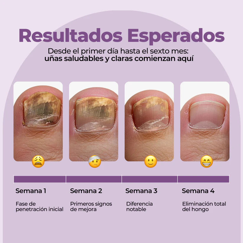 FUNGIVEX: El aceite que elimina el 99.9% de los hongos en tus uñas.