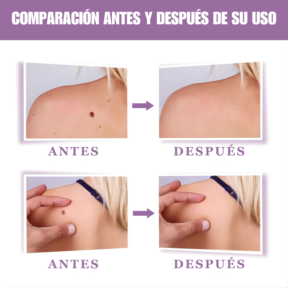 Luminiix Eliminador de verrugas natural avanzado: resultados rápidos, indoloros y sin cicatrices