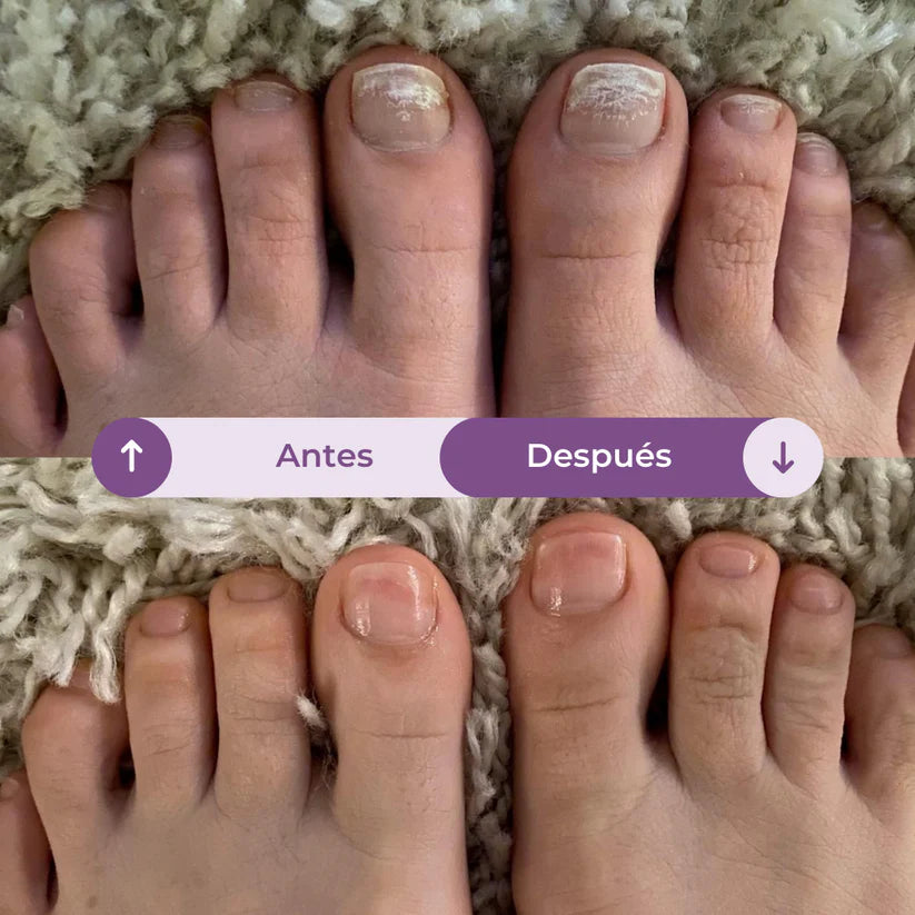 FUNGIVEX: El aceite que elimina el 99.9% de los hongos en tus uñas.