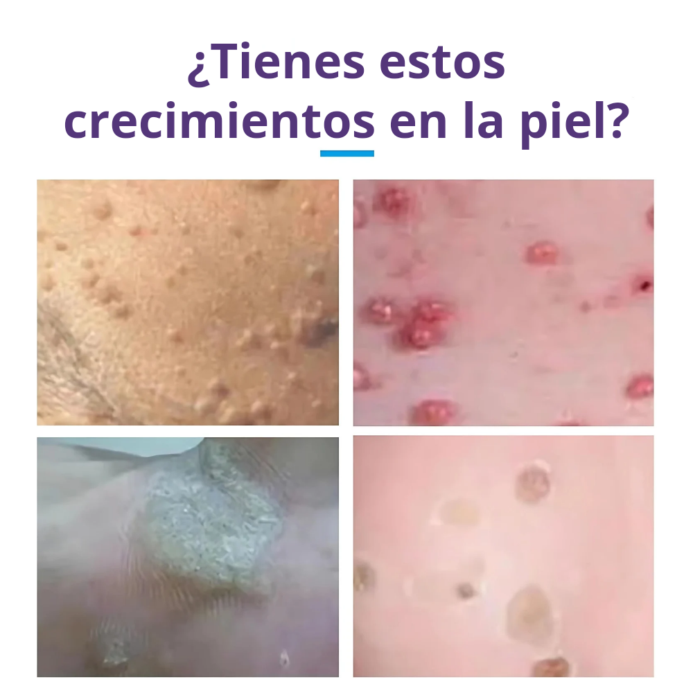 Luminiix Eliminador de Verrugas