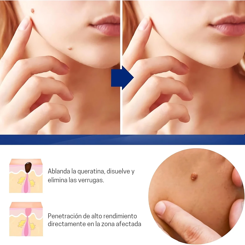 Luminiix Eliminador de Verrugas