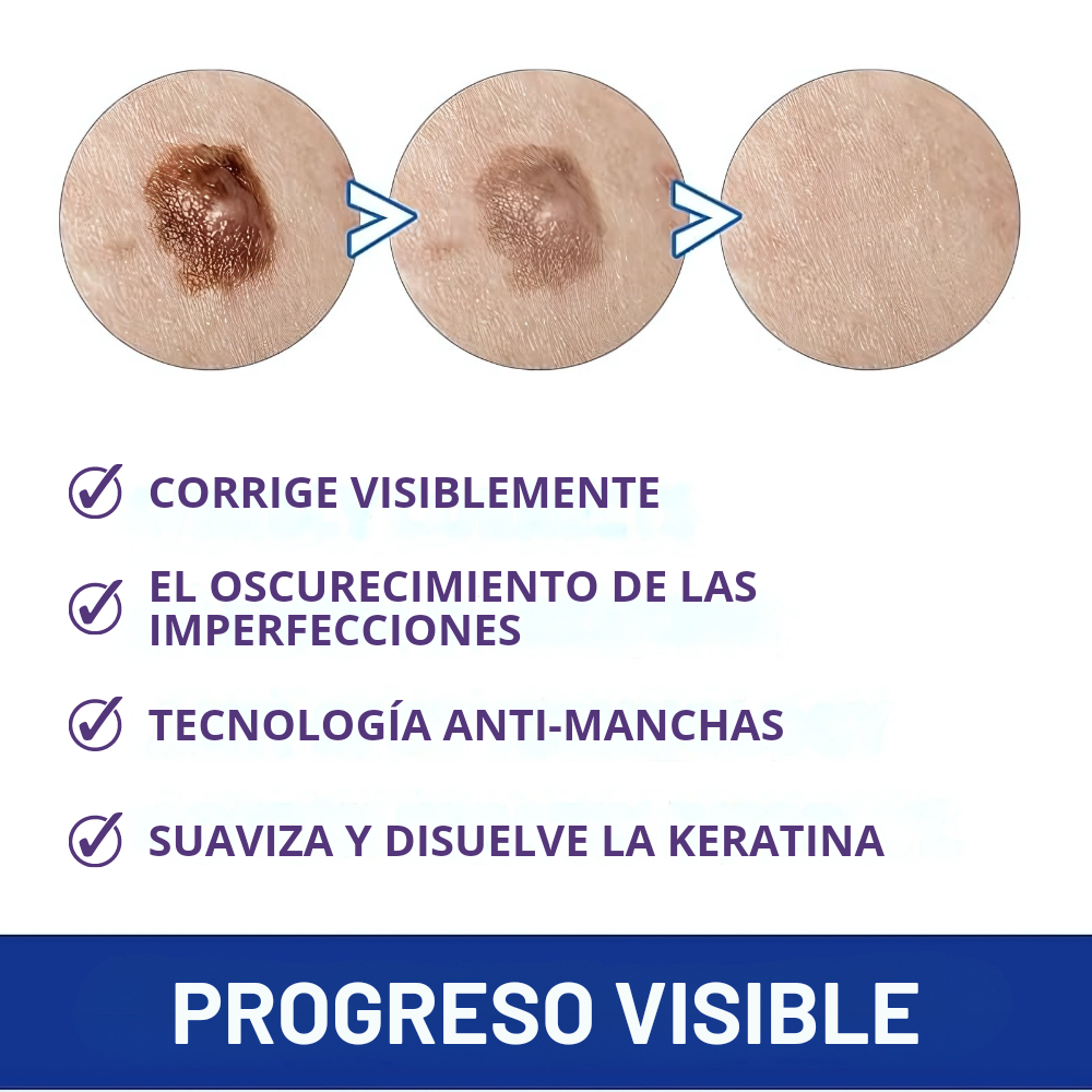 Luminiix Eliminador de Verrugas