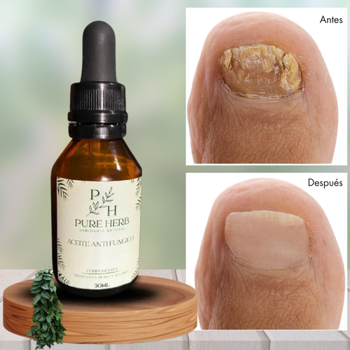 Aceite Antihongos Natural – Tratamiento para Uñas