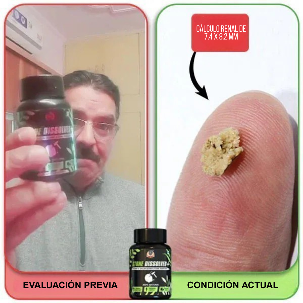 Stone Dissolver+ – Suplemento Natural para Eliminar Cálculos Renales y Proteger la Salud Urinaria