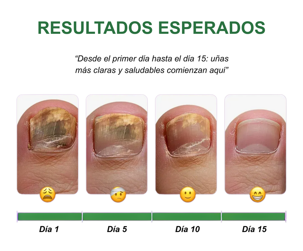Aceite Antihongos Natural – Tratamiento para Uñas