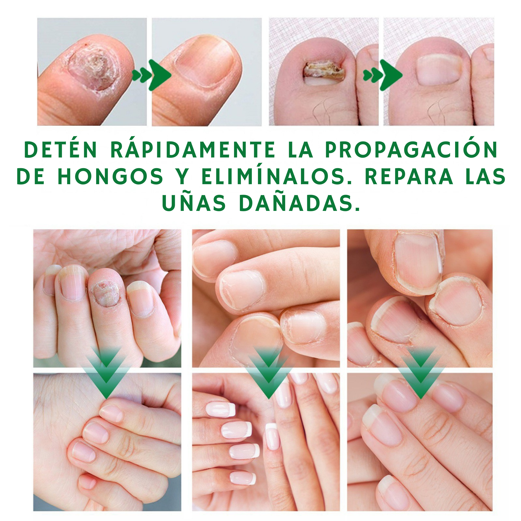 Uñas Libres de Hongos en 7 Días – Tratamiento Natural y Efectivo