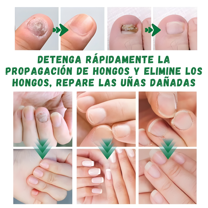 Tratamiento de 7 días para hongos en las uñas: Rápido, natural y eficaz "OFERTA 2x1"