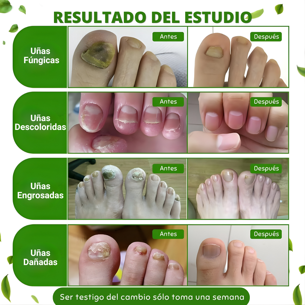 Tratamiento para hongos en las uñas: uñas más sanas, limpias y fuertes desde la raíz.