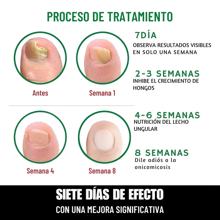 Tratamiento de 7 días para hongos en las uñas: Rápido, natural y eficaz "OFERTA 2x1"