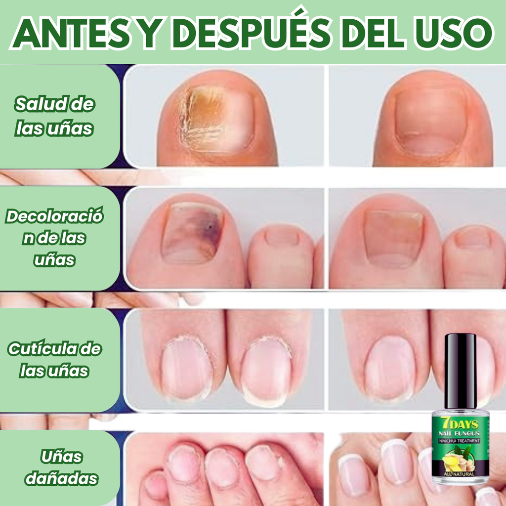 Uñas Libres de Hongos en 7 Días – Tratamiento Natural y Efectivo