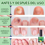 Uñas Libres de Hongos en 7 Días – Tratamiento Natural y Efectivo