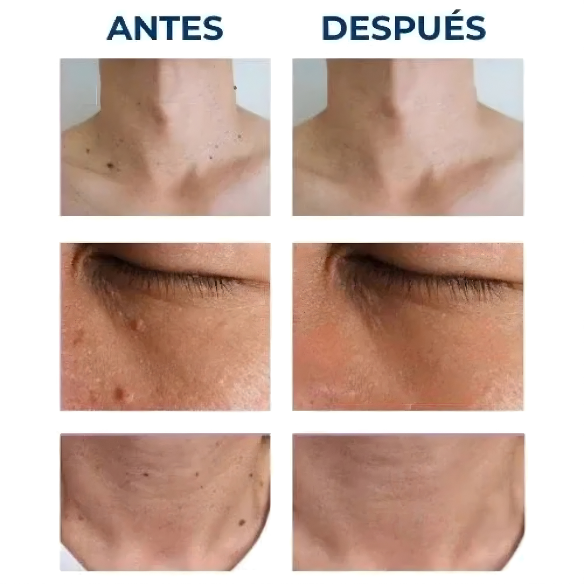 Luminiix – Eliminador natural de verrugas para una piel suave y limpia