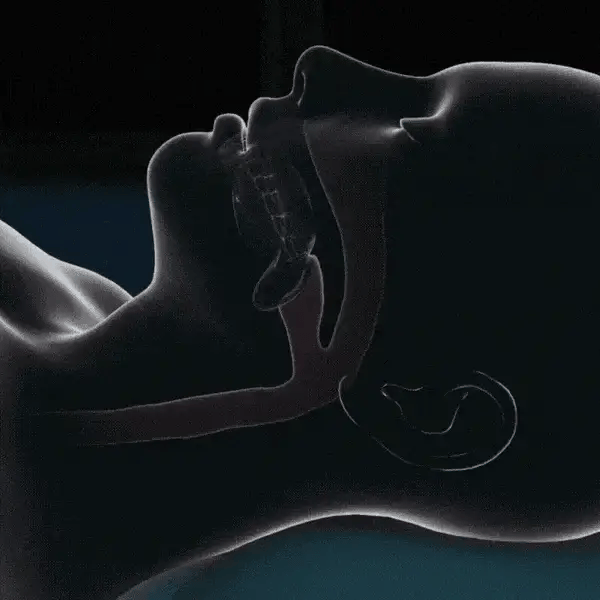 Protector bucal antironquidos: Duerme en silencio y despierta renovado