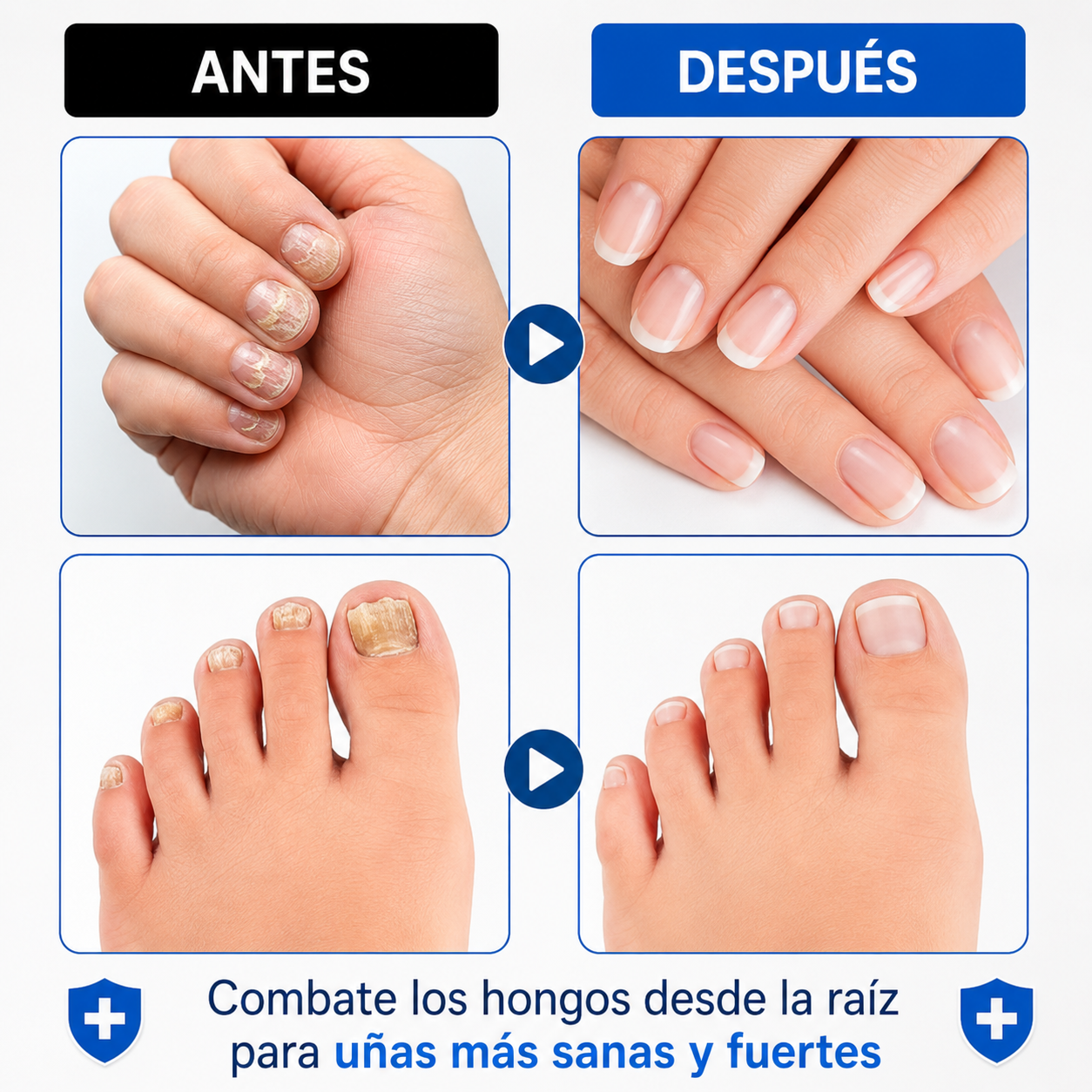 Fórmula Anti-Hongos – Uñas Renovadas y de Aspecto Saludable