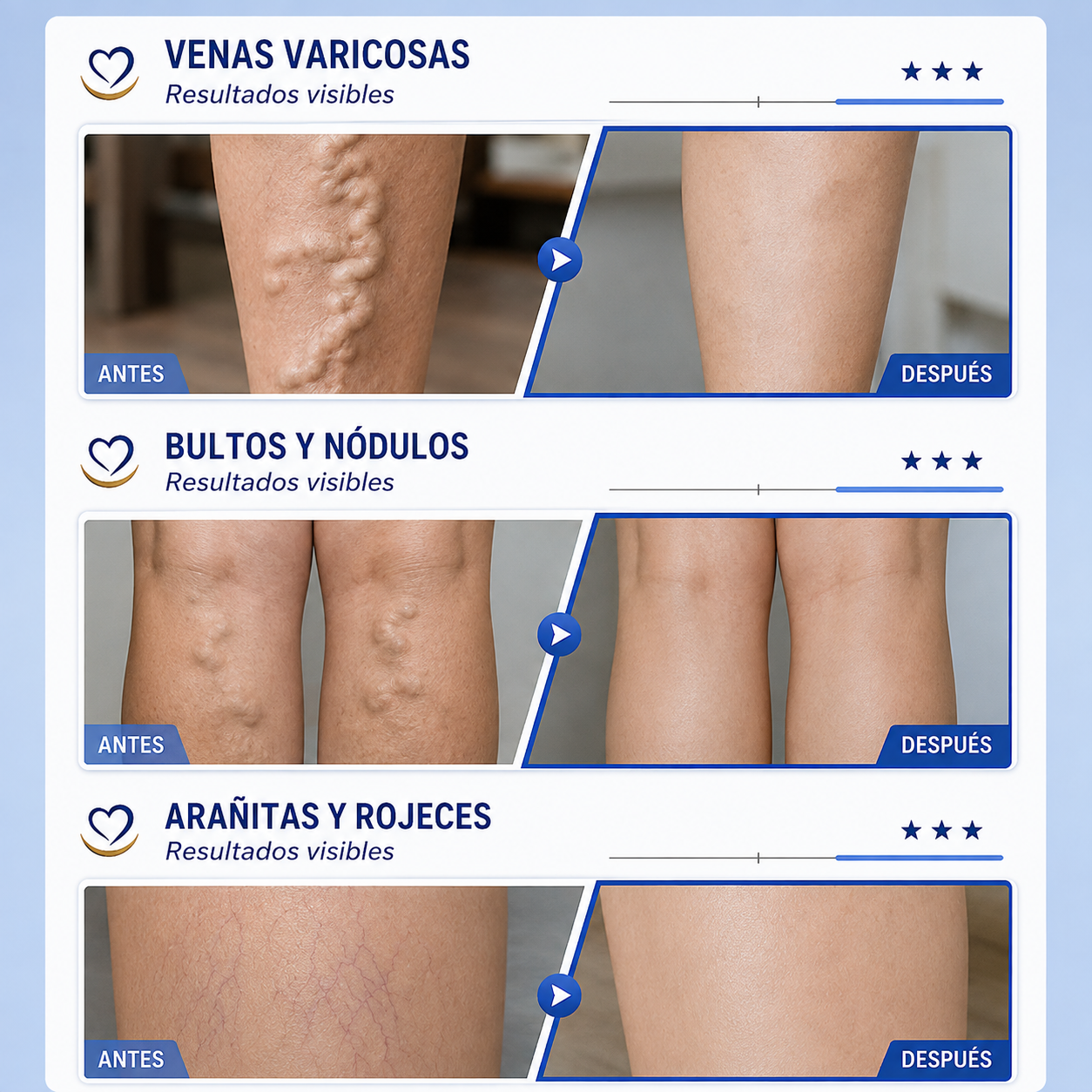 Crema para las Varices - Siente Tus Piernas Más Ligeras, Frescas y Cómodas Cada Día (Oferta 2x1)