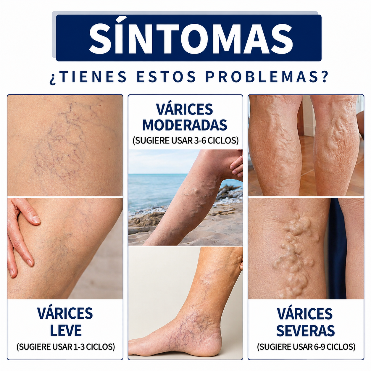 Crema para las Varices - Siente Tus Piernas Más Ligeras, Frescas y Cómodas Cada Día (Oferta 2x1)