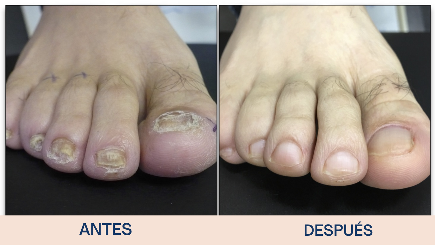 Uñas Libres de Hongos en 7 Días – Tratamiento Natural y Efectivo