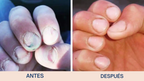 Uñas Libres de Hongos en 7 Días – Tratamiento Natural y Efectivo