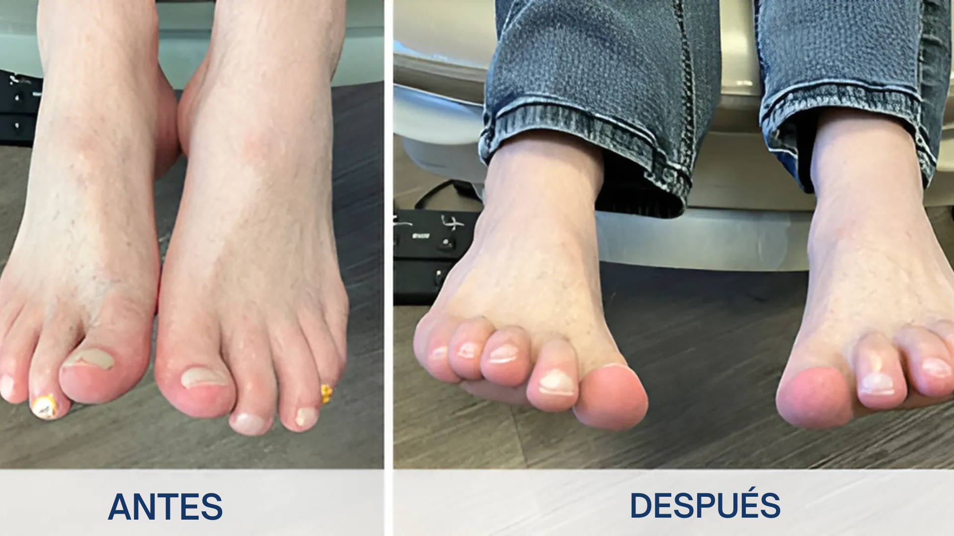 Uñas Libres de Hongos en 7 Días – Tratamiento Natural y Efectivo