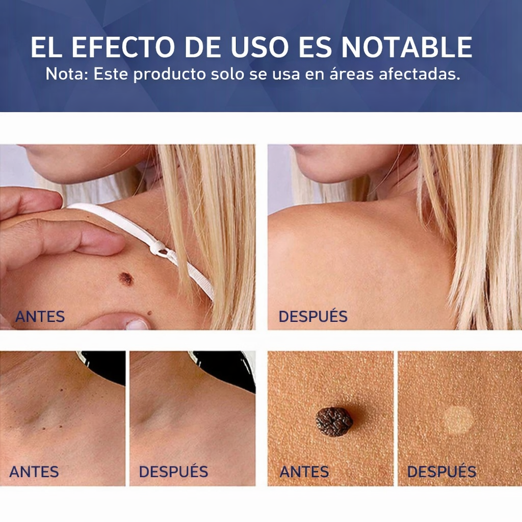 Gel para eliminar verrugas Verruxa: tratamiento avanzado para una piel limpia y sana.