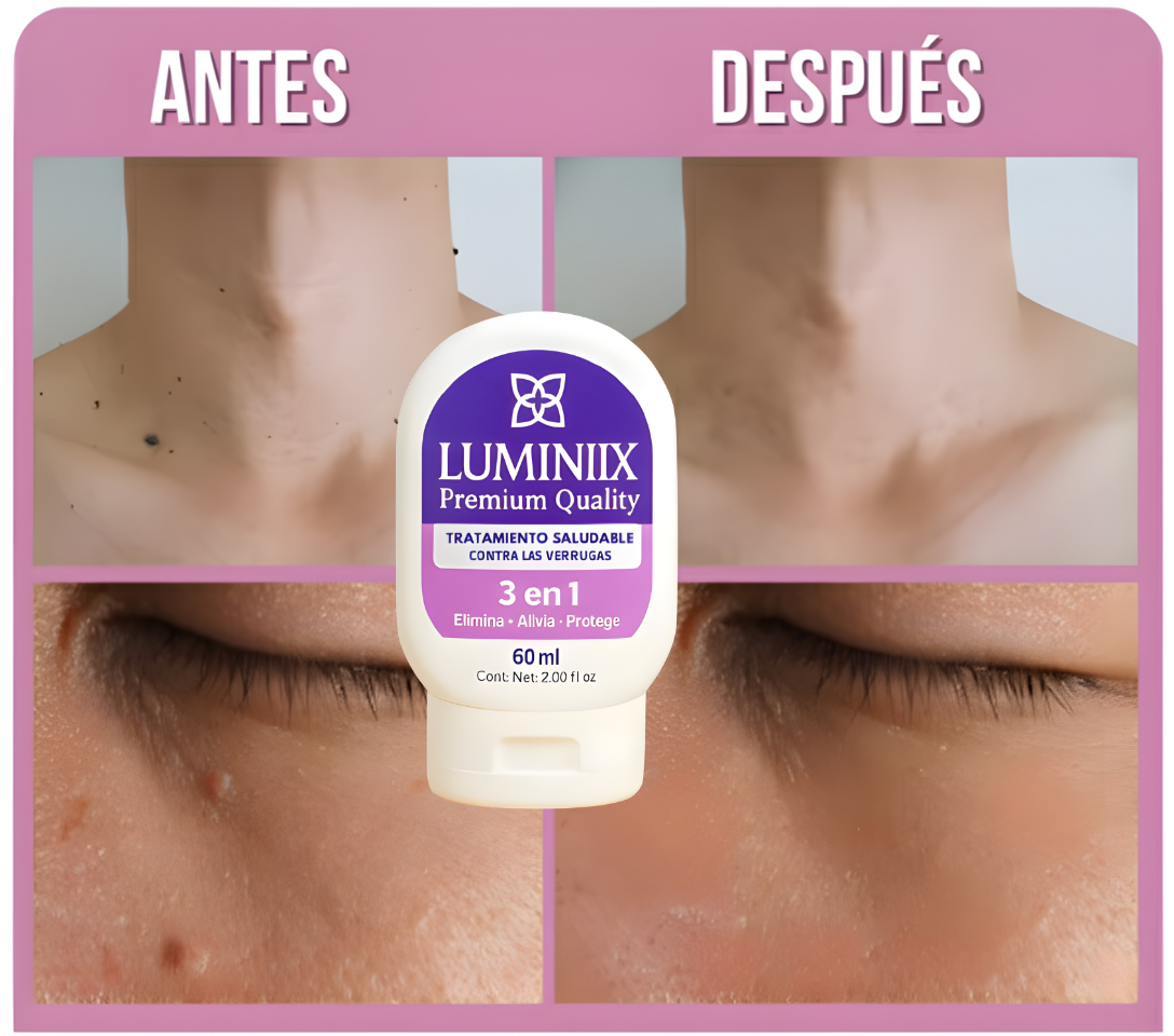Luminiix - "Removedor de Verrugas"