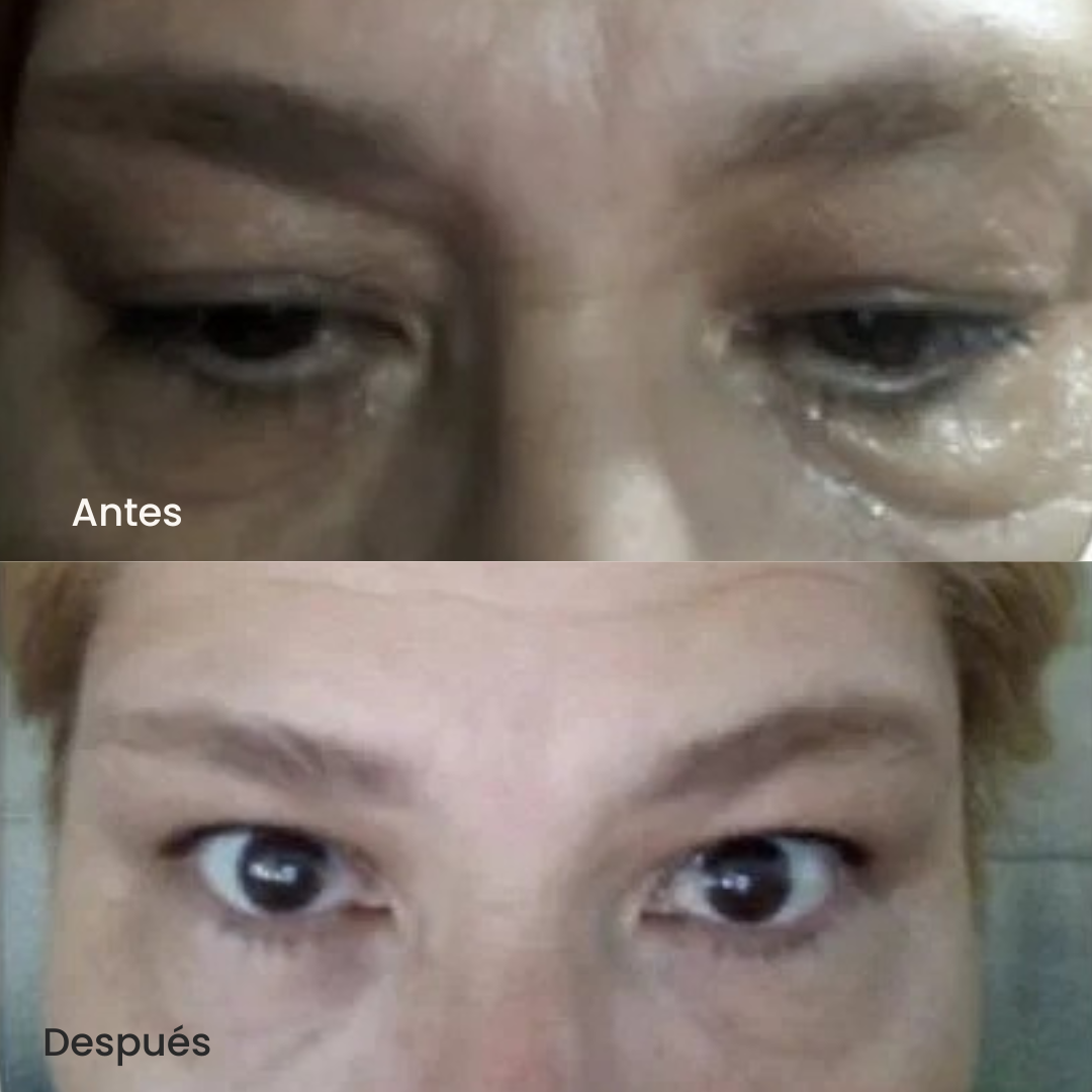 Roller Anti-Ojeras con Ácido Hialurónico – Reduce Bolsas al Instante