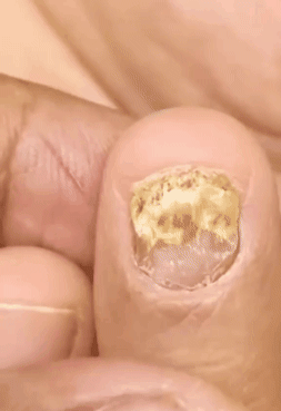 Uñas Libres de Hongos en 7 Días – Tratamiento Natural y Efectivo