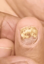 Uñas Libres de Hongos en 7 Días – Tratamiento Natural y Efectivo