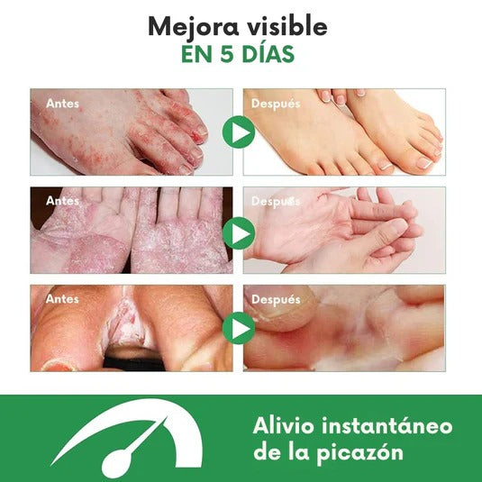 Spray para pie de atleta