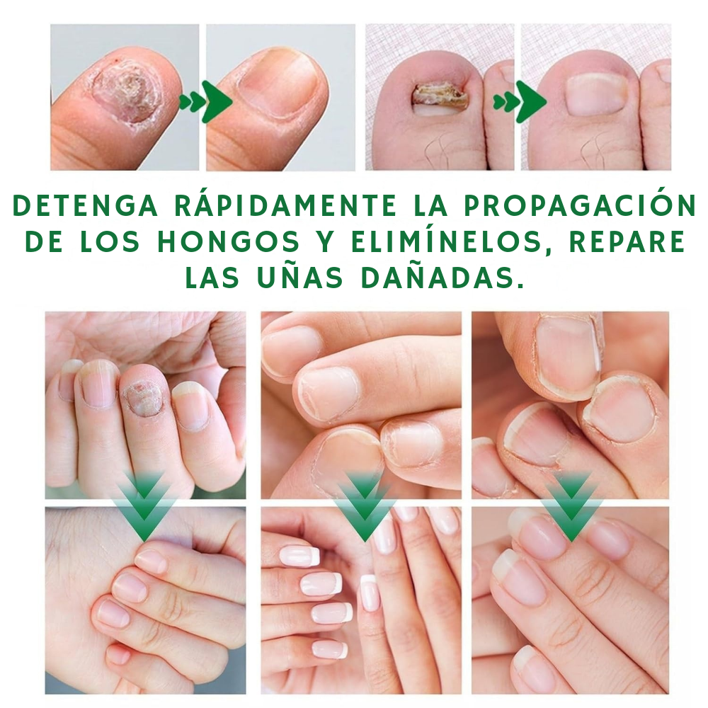 Uñas Libres – Confianza en 7 Días
